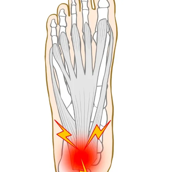 【足底筋膜炎】