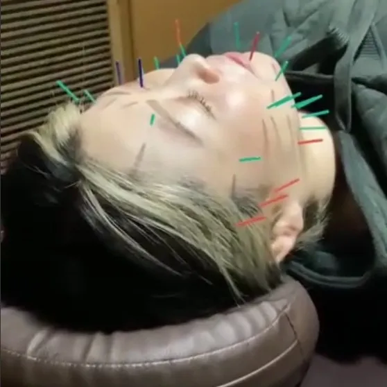 【美容鍼でお顔のむくみ解消！！】