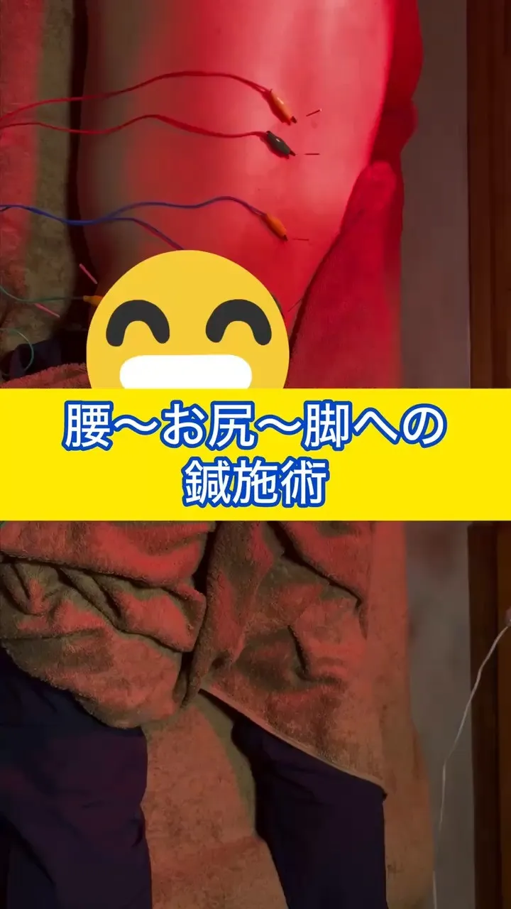 【腰痛等への鍼施術】